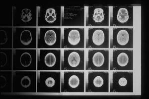Whole Body MRI (Ολόσωμη Μαγνητική Τομογραφία): Σύγχρονη απεικόνιση για την έγκαιρη ανίχνευση σημαντικών ευρημάτων