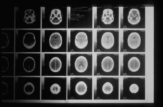 Whole Body MRI (Ολόσωμη Μαγνητική Τομογραφία): Σύγχρονη απεικόνιση για την έγκαιρη ανίχνευση σημαντικών ευρημάτων